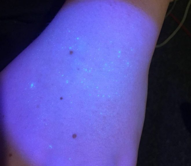 A 13 YEAR OLD BOY WHO WAS ADMINISTERED THE FLU NASAL SPRAY – WHICH IS KILLING CHILDREN IS NOW SHOWING SIGNS OF THE BIOLUMINESCENT TRACKING HYDROGEL UNDER HIS SKIN – THE PERSON WHO DID THS TO THIS BOY IS FUCKED!!